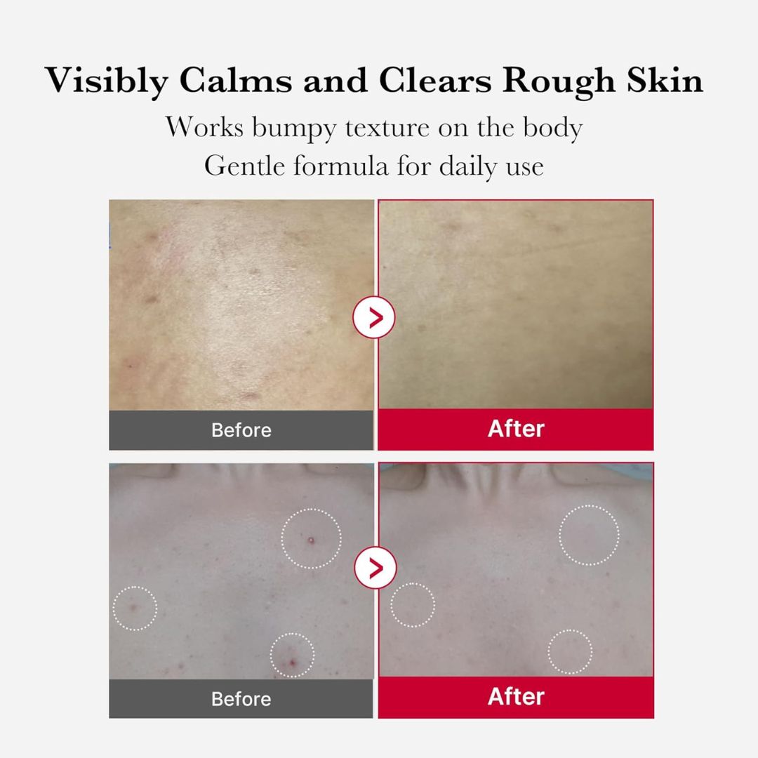 Medicube - Red Acne Body Peeling Shot 110g